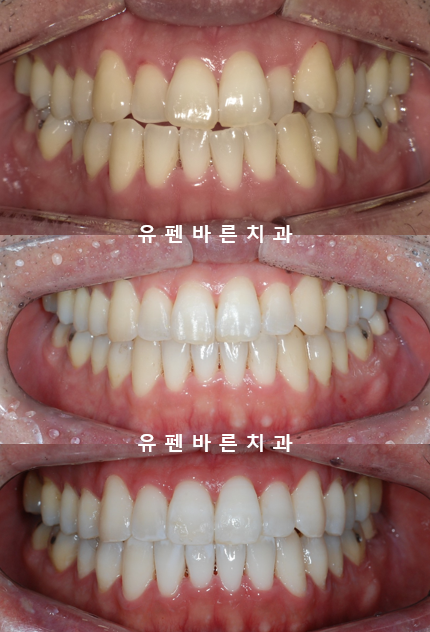 안면비대칭, 잠실수술교정, 잠실양악수술도 유펜바른치과입니다. 관련 이미지 12