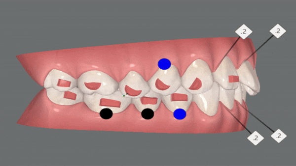 앞니부분교정 인비절라인라이트로 해결하기 (잠실인비절라인치과 송파인비절라인치과 잠실새내인비절라인치과 강동인비절라인치과 헬리오시티인비절라인 송파역인비절라인 석촌역인비절라인) 관련 이미지 9