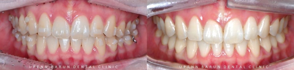 앞니부분교정 인비절라인라이트로 해결하기 (잠실인비절라인치과 송파인비절라인치과 잠실새내인비절라인치과 강동인비절라인치과 헬리오시티인비절라인 송파역인비절라인 석촌역인비절라인) 관련 이미지 12