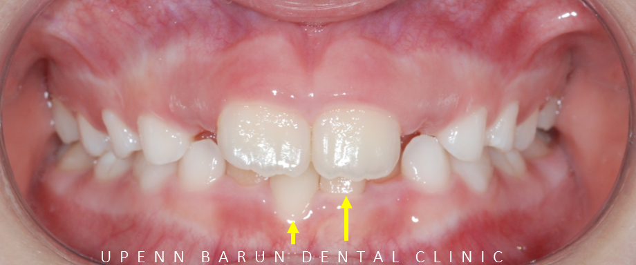 송파인비절라인퍼스트 인비절라인어린이교정 11개월만에 끝낸 후기(잠실인비절라인 잠실파인애플상가교정치과 인비절라인소아교정후기 인비절라인플래티넘엘리트등급) 관련 이미지 6