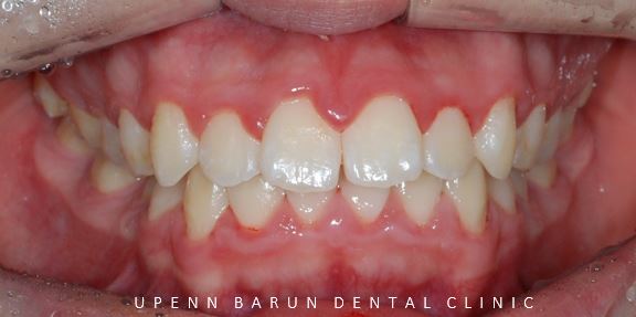 잠실청소년교정 청소년소년돌출입교정 잠실발치교정은 유펜바른치과에서! (잠실나루역교정치과 삼전역교정치과 잠실새내교정치과 돌출입전후 발치교정전후사진) 관련 이미지 4