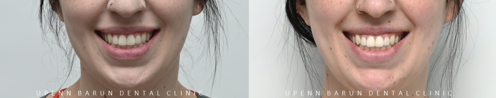 가지런했던 앞니가 삐뚤빼뚤해졌어요! 잠실다이아몬드등급 잠실인비절라인 인비절라인익스프레스 앞니 삐뚤어짐 해결(앞니급속교정 앞니투명교정 인비절라인급속교정 인비절라인전후사진) 관련 이미지 13