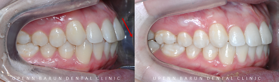 가지런했던 앞니가 삐뚤빼뚤해졌어요! 잠실다이아몬드등급 잠실인비절라인 인비절라인익스프레스 앞니 삐뚤어짐 해결(앞니급속교정 앞니투명교정 인비절라인급속교정 인비절라인전후사진) 관련 이미지 5