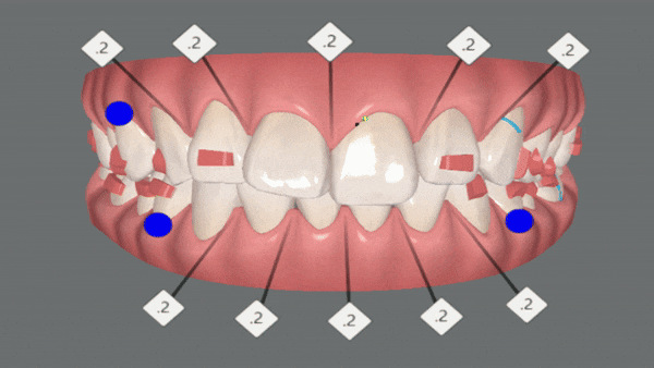 앞니부분교정 인비절라인라이트로 해결하기 (잠실인비절라인치과 송파인비절라인치과 잠실새내인비절라인치과 강동인비절라인치과 헬리오시티인비절라인 송파역인비절라인 석촌역인비절라인) 관련 이미지 8