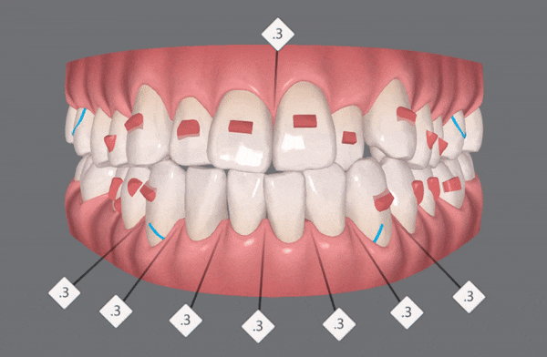 나스닥에 상장한 인비절라인, 잠실투명교정 잠실인비절라인 후기와 치아미백이 궁금하다면? 관련 이미지 6