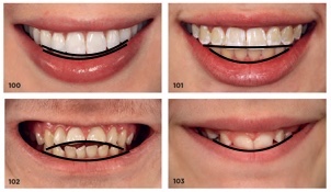 Smile Esthetics (예쁜 미소의 기준) 1편: 스마일 아크 관련 이미지 1