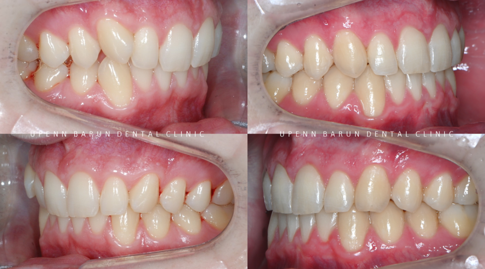 '옥니같이 보여요' 인비절라인급속교정 가능할까? with 캐리에모션장치 (잠실다이아몬드등급 인비절라인다이아몬드등급 서울다이아몬드등급치과 옥니인비절라인후기) 관련 이미지 17