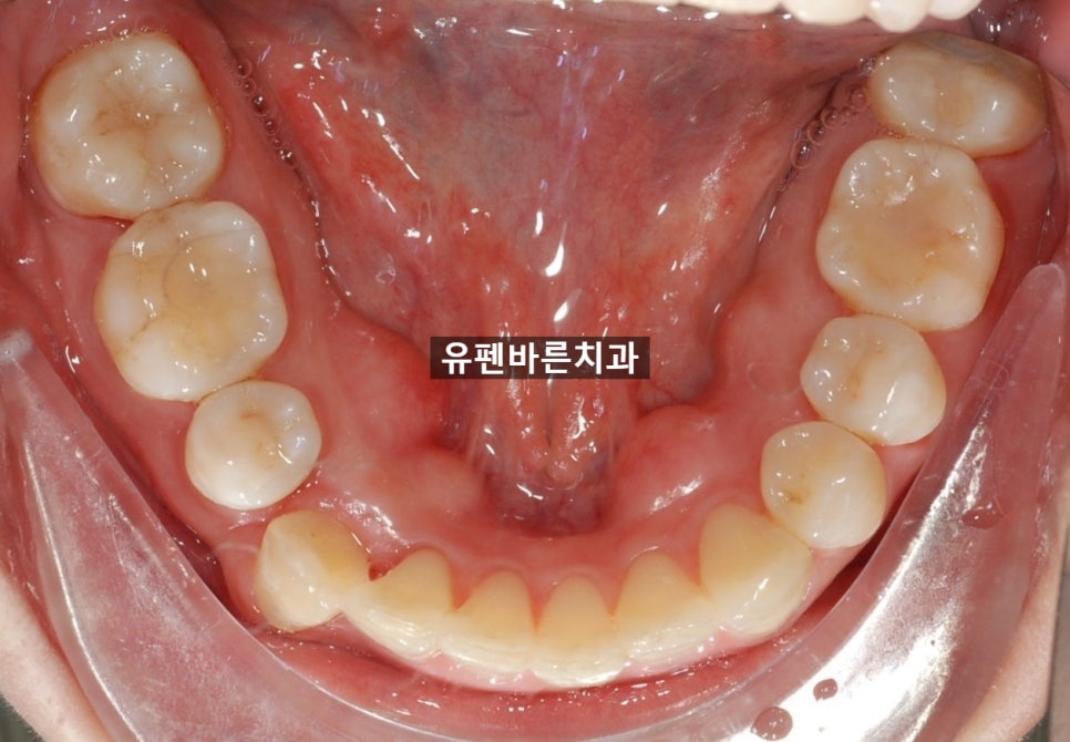 해외거주 중인데 발치교정도 인비절라인으로 가능한가요? 관련 이미지 10