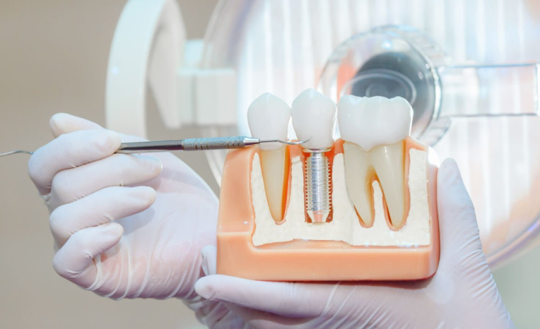 Comprehensive Implant Dentistry for Expats in Jamsil, Seoul 관련 이미지 3