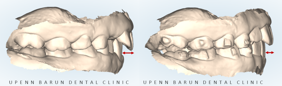 송파인비절라인퍼스트 인비절라인어린이교정 11개월만에 끝낸 후기(잠실인비절라인 잠실파인애플상가교정치과 인비절라인소아교정후기 인비절라인플래티넘엘리트등급) 관련 이미지 13