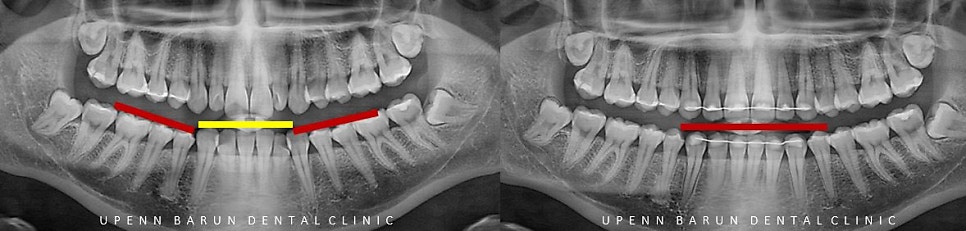 비발치 세라믹교정 후기 (앞니교정 잠실부분교정 잠실교정치과 잠실새내교정치과) 관련 이미지 9