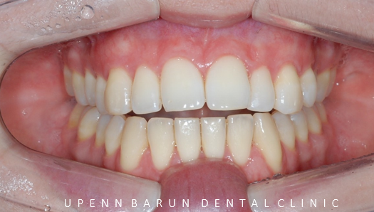 개방교합은 교정용 미니스크류 쓰지말고 인비절라인만으로 쉽게 해결하세요! (잠실인비절라인  잠실새내인비절라인  개방교합교정  잠실새내교정치과) 관련 이미지 8