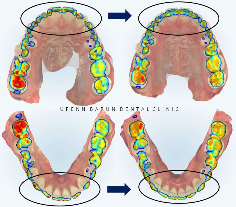 20대 여성 앞니 사이 틈 2개월만에 해결 (인비절라인익스프레스 INVISALIGN EXPRESS 인비절라인후기 잠실인비절라인  잠실투명교정치과) 관련 이미지 8