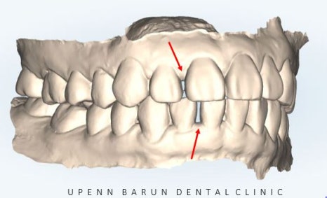 20대 여성 앞니 사이 틈 2개월만에 해결 (인비절라인익스프레스 INVISALIGN EXPRESS 인비절라인후기 잠실인비절라인  잠실투명교정치과) 관련 이미지 4