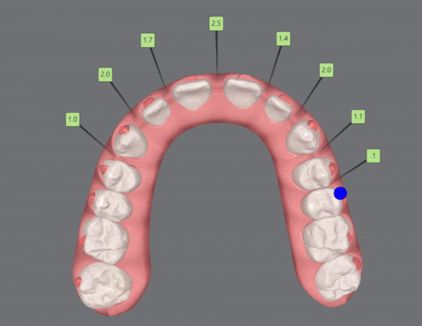 인비절라인높은등급 인비절라인플래티넘엘리트 잠실교정치과 잠실인비절라인 (잠실교정치과 송파인비절라인 인비절라인전후사진 인비절라인후기) 관련 이미지 11