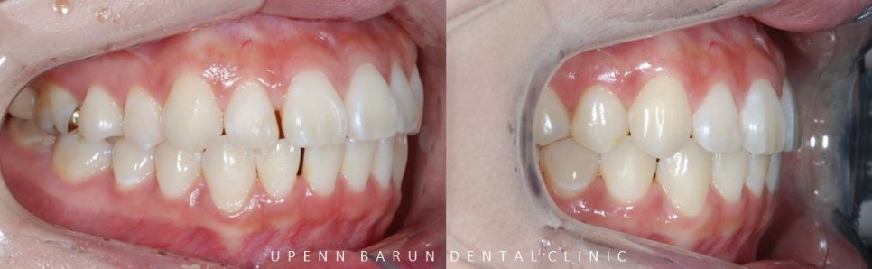 20대 여성 앞니 사이 틈 2개월만에 해결 (인비절라인익스프레스 INVISALIGN EXPRESS 인비절라인후기 잠실인비절라인  잠실투명교정치과) 관련 이미지 7