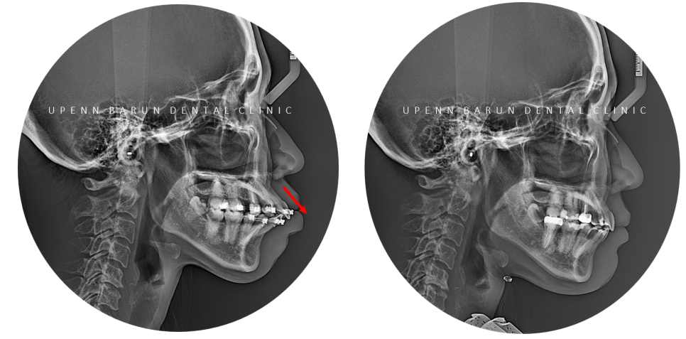 수술이 필요없는 잠실돌출입교정 잠실교정치과 입술이 잘 안다물어져 고민이라면? (돌출입전후 잠실새내교정치과 잠실발치교정 발치교정전후사진) 관련 이미지 9