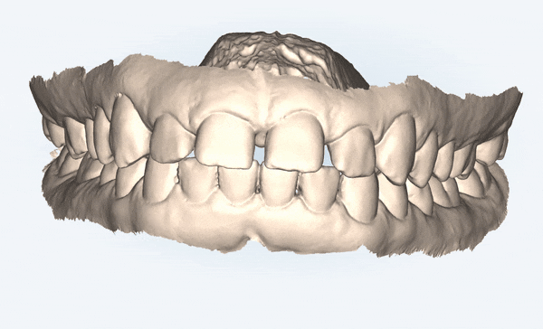 잠실인비절라인등급 잠실부분교정 앞니틈교정 인비절라인라이트 옵션으로 빠르게 해결한 후기 (삼성역부분교정 인비절라인앞니재교정 잠실역교정치과 삼전동인비절라인 삼전동교정치과) 관련 이미지 3