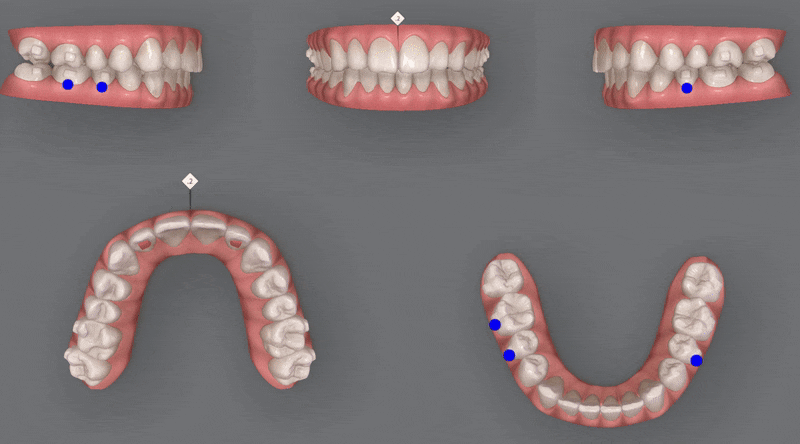 인비절라인을 시작할때 고려해야 하는 세가지 조건 (인비절라인다이아몬드 다이아몬드등급치과 인비절라인앞니교정 앞니급속교정 비발치교정 치간삭제 치간삭제양) 관련 이미지 13
