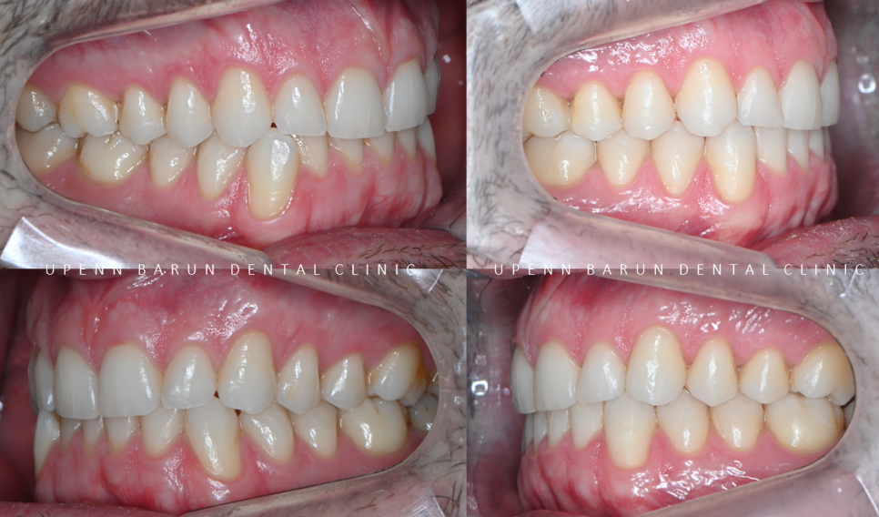 인비절라인다이아몬드등급치과에서 28개의 교정장치로 고민 해결한 후기가 궁금하다면? (잠실송곳니덧니교정 잠실인비절라인 인비절라인교정기간 투명교정장치후기 잠실인비절라인후기) 관련 이미지 11