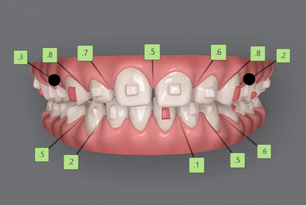 인비절라인높은등급 인비절라인플래티넘엘리트 잠실교정치과 잠실인비절라인 (잠실교정치과 송파인비절라인 인비절라인전후사진 인비절라인후기) 관련 이미지 12
