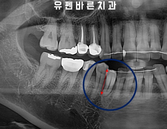 앞니부분교정 잠실인비절라인 라이트 옵션 들어보셨나요? 관련 이미지 9