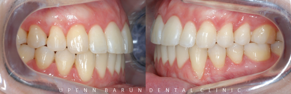 개방교합은 교정용 미니스크류 쓰지말고 인비절라인만으로 쉽게 해결하세요! (잠실인비절라인  잠실새내인비절라인  개방교합교정  잠실새내교정치과) 관련 이미지 7