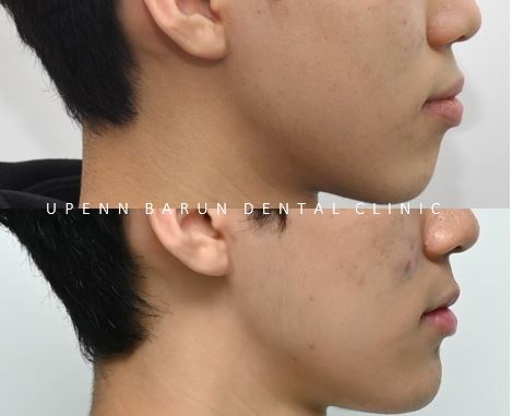 잠실청소년교정 청소년소년돌출입교정 잠실발치교정은 유펜바른치과에서! (잠실나루역교정치과 삼전역교정치과 잠실새내교정치과 돌출입전후 발치교정전후사진) 관련 이미지 3