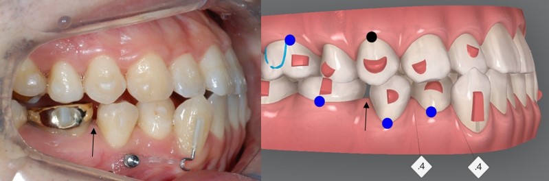 치과위생사의 인비절라인 두번째 이야기 관련 이미지 3