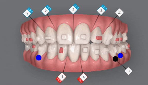 인비절라인 공식 스피커가 상주하고 치료하는 송파교정잘하는치과 유펜바른치과 (잠실성인교정 잠실재교정 잠실인비절라인 성인인비절라인교정 잠실나루역교정치과 문정동교정치과 삼전역교정치과) 관련 이미지 9