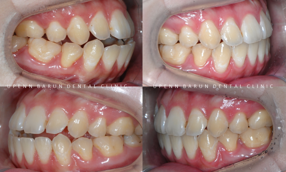 반대교합+개방교합 비수술교정 유펜바른치과에서 재교정한 후기! ( 비발치개방교합 비발치반대교합 재교정후기 잠실교정치과 미니스크류비수술교정 악궁확장장치 MARPE) 관련 이미지 10