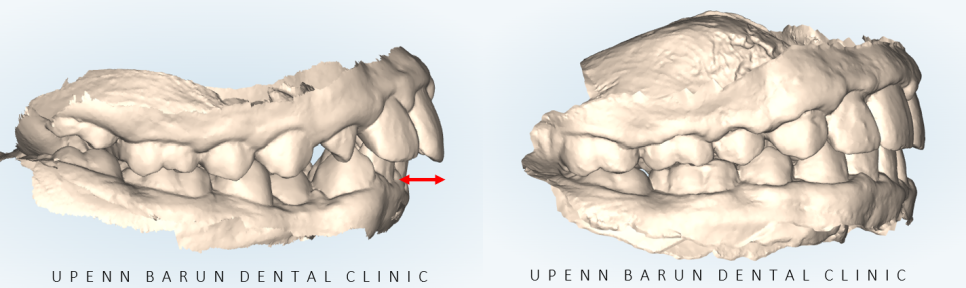 성장기에 돌출입이 고민이라면? 돌출입청소년교정 입술무력증 해결도 유펜바른치과에서! (잠실청소년교정 잠실돌출입교정 돌출입교정기간 발치교정외모변화 외국인교정치과) 관련 이미지 7