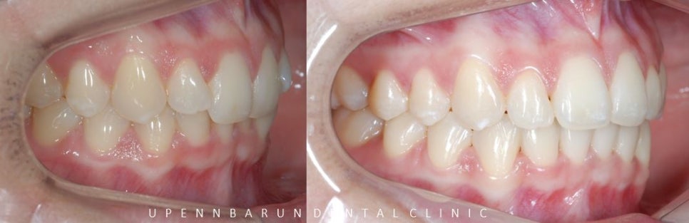 비발치 세라믹교정 후기 (앞니교정 잠실부분교정 잠실교정치과 잠실새내교정치과) 관련 이미지 6