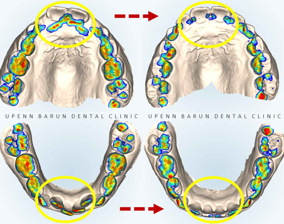 송파인비절라인퍼스트 인비절라인어린이교정 11개월만에 끝낸 후기(잠실인비절라인 잠실파인애플상가교정치과 인비절라인소아교정후기 인비절라인플래티넘엘리트등급) 관련 이미지 5