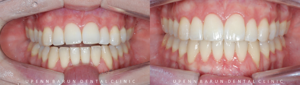 개방교합은 교정용 미니스크류 쓰지말고 인비절라인만으로 쉽게 해결하세요! (잠실인비절라인  잠실새내인비절라인  개방교합교정  잠실새내교정치과) 관련 이미지 16