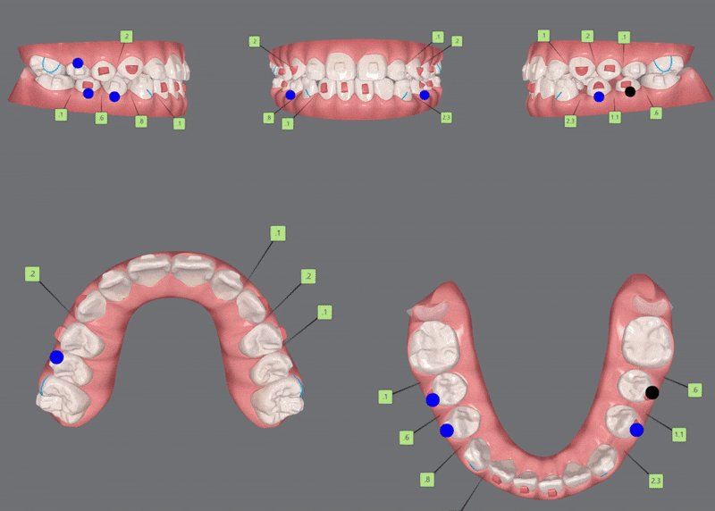 송파인비절라인다이아몬드등급치과 에서 인비절라인으로 1차 2차 교정을 한번에! (송파인비절라인퍼스트 잠실어린이인비절라인 인비절라인소아교정 잠실소아교정 어린이반대교합) 관련 이미지 14