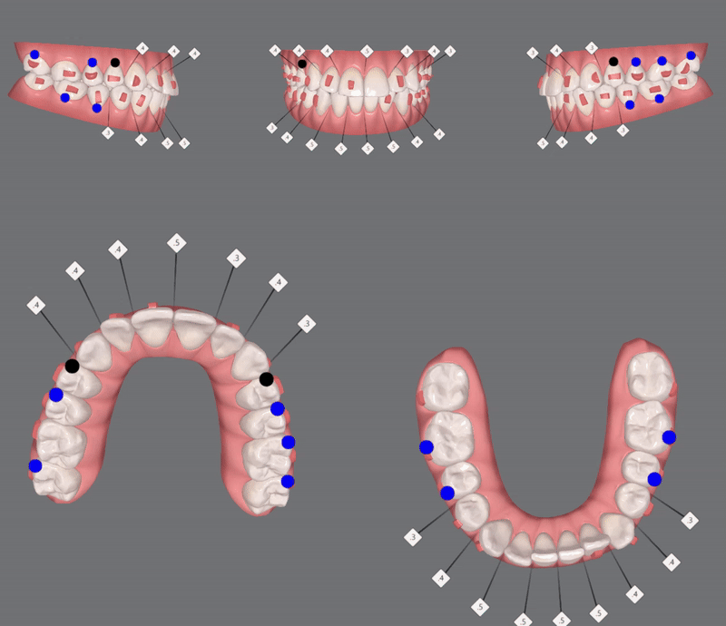 "치아가 앞으로 뻐드러졌어요!" 송파인비절라인다이아몬드등급치과에서!!(비발치인비절라인 뻐드렁니교정치과 돌출입교정치과) 관련 이미지 9