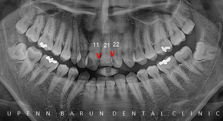 잠실데이몬교정, 비발치교정, 잠실덧니교정 (AKA Damon Smile) 관련 이미지 3