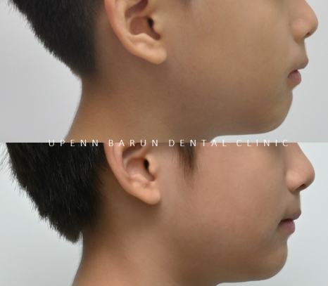 송파인비절라인퍼스트 인비절라인어린이교정 11개월만에 끝낸 후기(잠실인비절라인 잠실파인애플상가교정치과 인비절라인소아교정후기 인비절라인플래티넘엘리트등급) 관련 이미지 21