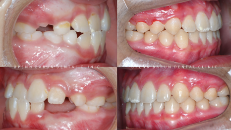 다이아몬드등급치과에서 인비절라인퍼스트로 반대교합 해결! 1차, 2차교정을 한번에!( 어린이반대교합 송파인비절라인퍼스트 잠실엘스상가교정치과 잠실인비절라인퍼스트 인비절라인스피커치과) 관련 이미지 19