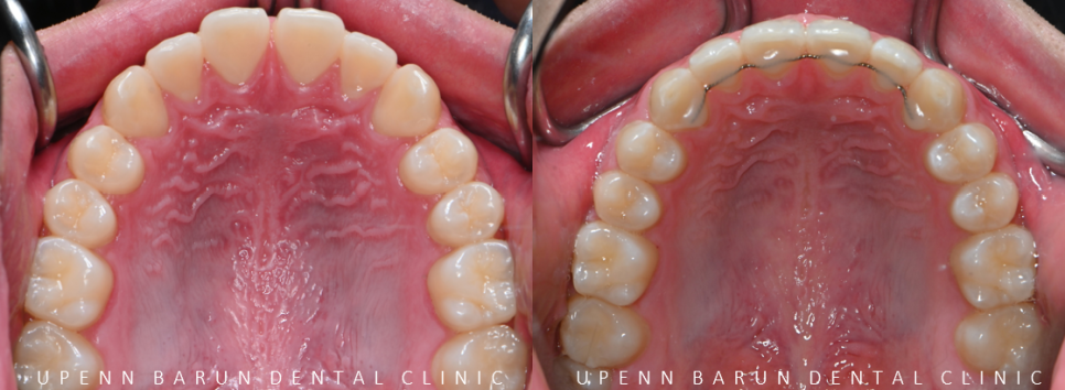 인비절라인다이아몬드등급치과에서 7주만에 앞니벌어짐 고민 해결한 후기(인비절라인앞니교정 인비절라인익스프레스 잠실인비절라인 인비절라인앞니교정후기) 관련 이미지 10