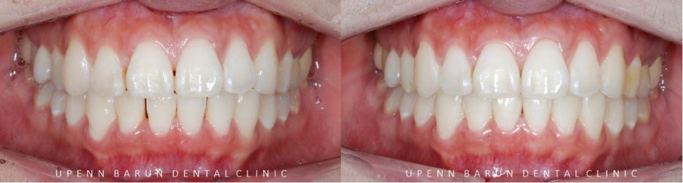 20대 여성 앞니 사이 틈 2개월만에 해결 (인비절라인익스프레스 INVISALIGN EXPRESS 인비절라인후기 잠실인비절라인  잠실투명교정치과) 관련 이미지 5
