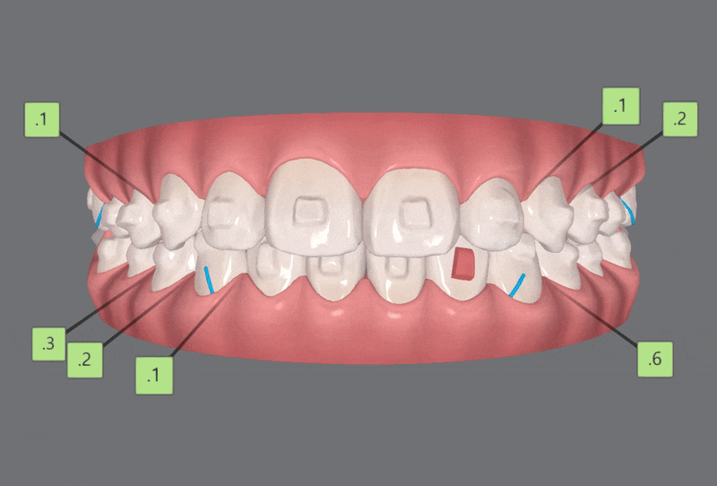 송파인비절라인다이아몬드등급치과 에서 인비절라인으로 1차 2차 교정을 한번에! (송파인비절라인퍼스트 잠실어린이인비절라인 인비절라인소아교정 잠실소아교정 어린이반대교합) 관련 이미지 15
