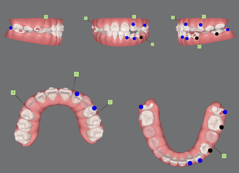다이아몬드등급치과에서 인비절라인퍼스트로 반대교합 해결! 1차, 2차교정을 한번에!( 어린이반대교합 송파인비절라인퍼스트 잠실엘스상가교정치과 잠실인비절라인퍼스트 인비절라인스피커치과) 관련 이미지 13