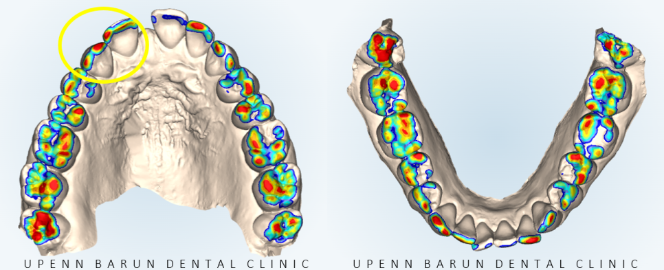같은원장님께 보철치료와 교정치료를 동시에! 앞니사이 틈 해결한 후기 ( 송파교정치과 잠실교정잘하는치과 송파교정잘하는치과 올림픽파크포레온교정치과 올림픽파크포레온인비절라인치과) 관련 이미지 6