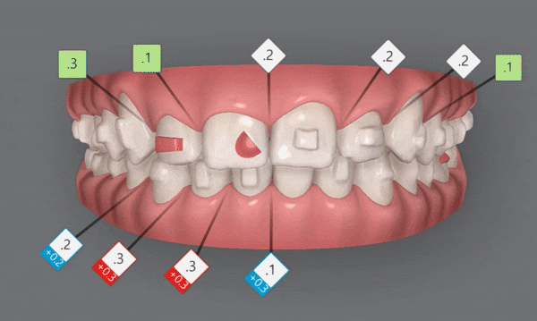 잠실인비절라인등급 잠실부분교정 앞니틈교정 인비절라인라이트 옵션으로 빠르게 해결한 후기 (삼성역부분교정 인비절라인앞니재교정 잠실역교정치과 삼전동인비절라인 삼전동교정치과) 관련 이미지 11