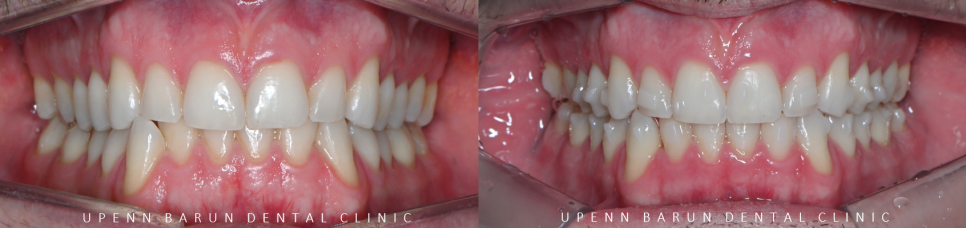인비절라인다이아몬드등급치과에서 28개의 교정장치로 고민 해결한 후기가 궁금하다면? (잠실송곳니덧니교정 잠실인비절라인 인비절라인교정기간 투명교정장치후기 잠실인비절라인후기) 관련 이미지 7