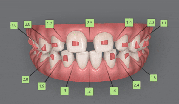 인비절라인높은등급 인비절라인플래티넘엘리트 잠실교정치과 잠실인비절라인 (잠실교정치과 송파인비절라인 인비절라인전후사진 인비절라인후기) 관련 이미지 8