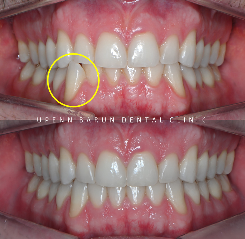 인비절라인다이아몬드등급치과에서 28개의 교정장치로 고민 해결한 후기가 궁금하다면? (잠실송곳니덧니교정 잠실인비절라인 인비절라인교정기간 투명교정장치후기 잠실인비절라인후기) 관련 이미지 3