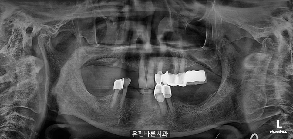 연세가 엄청 많으신데도 전체 임플란트 수술이 가능하다구요? 관련 이미지 3